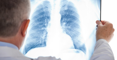 SPP defende diagnóstico precoce e rastreio ao cancro do pulmão