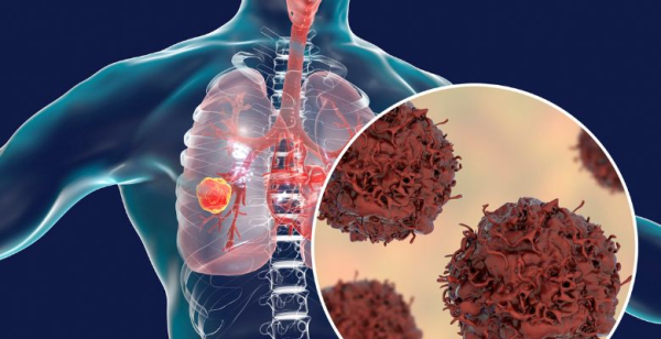 Em cada 10 novos diagnósticos de cancro do pulmão de pequenas células, sete apresentam doença extensa
