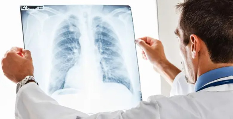 Infarmed aprova comparticipação de nintedanib para o tratamento da fibrose pulmonar idiopática